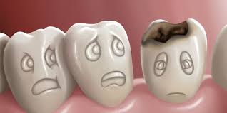 What causes cavities? And how to prevent cavities ?