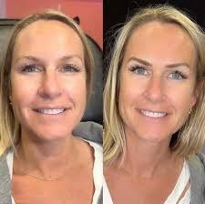 Angela Millar offers micro pigmentation at KMS. We love seeing her work 🖤  Eyeliner micro pigment is a great time saver for those busy clients or for  clients who want to make