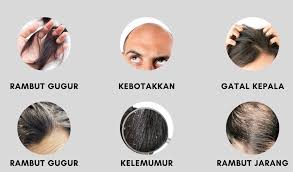 Hampir semua lelaki dan perempuan yang akil baligh di dunia mengalami masalah kelemumur. Punca Rambut Gugur Dan Kelemumur