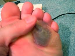 Maybe you would like to learn more about one of these? My No Frills Guide To Treating A Blood Blister Hubpages