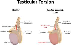 Check spelling or type a new query. Testicle Pain Orchiectomy Testicular Torsion Treatment Bangalore Twisted Balls Surgery India