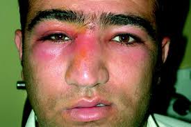 Nasal vestibulitis is a bacterial infection that starts in the hair follicles of the nose. Nasal Vestibulitis And Nasal Furunculosis And Mucormycosis Springerlink
