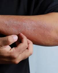 Image result for contact dermatitis