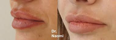 Cosmeceutical brand skinceuticals is well known for its advanced formulas that work. Pigmentation On Upper Lip Best Clinic Sydney For Dermal Fillers