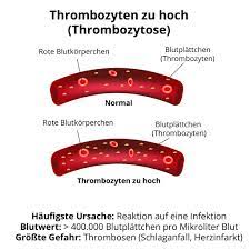 Thrombozyten Zu Hoch Thrombozytose