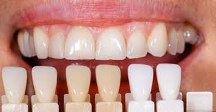 Kaplama Yapilan Disler Curur Mu Dentamer Estetik Dis Bursa