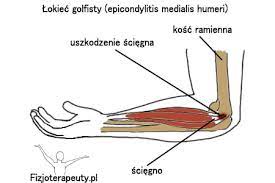 Głównym objawem jest ból po wewnętrznej stronie łokcia, który. Lokiec Golfisty Objawy Przyczyny Leczenie Portal Fizjoterapeuty