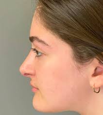 Rhinoplasty Before and After Photos
