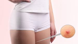 How To Get Rid Of Boils On Inner Thigh Top 10 Home Remedies