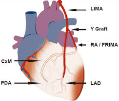 It is a diagonal artery simply because it runs diagonally the exact number of arteries in any one person are determined by genetics. Number Of Diagonal Arteries Coronary Artery Bypass Surgery Heart Bypass Redirects Here