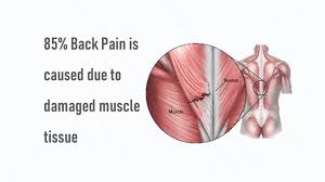 The upper, middle, and lower trapezius. Muscle Strain Treatment Back Neck Muscle Strain Treatment Causes