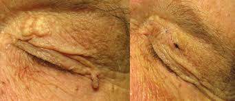 Maybe you would like to learn more about one of these? Skin Tag Removal On Eyelid Marsden Skin Cancer Clinic