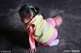 来源|发现妈妈（ id：vipfx77） 科技在发展，时代在进步，但人类好像越来越脆弱了，稍有不慎，便有死亡的危险。 1 5岁的欢欢聪明活泼，深受家人喜爱。 时至六月，天气渐热，欢欢的奶奶用黄豆发了不少豆芽做菜给家… 5å²å¥³å­©æ‚£ç™Œè…¿ç²—å¦‚è±¡è„š æ²¡é'±æ²»ç–—å¯èƒ½é¢ä¸´æ­»äº¡ æ–°é—» è›‹è›‹èµž