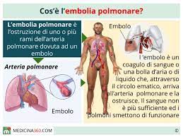Cilësia dhe ritmet e jetës të qelizave dhe të indit bashkëlidhës intesticial, janë të lidhura me përmbajtjen normale të. Embolia Polmonare Cause Sintomi Diagnosi Terapia E Conseguenze
