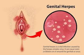Image result for genital herpes