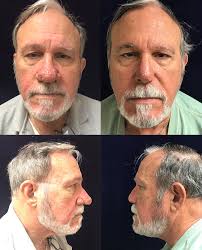 Rhinoplasty