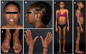 Image result for Lipodystrophy