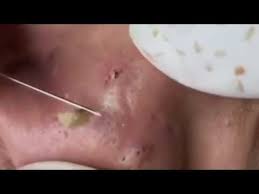 Nose Infection With Big Blackheads Acne Youtube