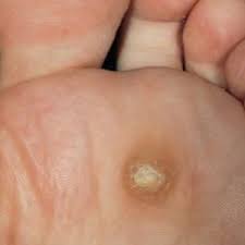 How To Treat Corns Naturally Corn Treatment Natural Health Tips Herbal Treatment
