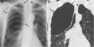 We did not find results for: Thoracic Abnormal Air Collections In Patients In The Intensive Care Unit Radiograph Findings Correlated With Ct Insights Into Imaging Full Text
