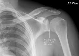 The shoulder joint is formed the rotator cuff is a collection of muscles and tendons that surround the shoulder, giving it. Posterior Shoulder Dislocation Litfl Medical Blog Trauma