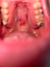Image result for oral thrush symptoms roof of the mouth