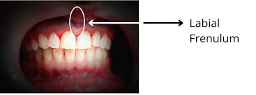 Image result for Ankyloglossia