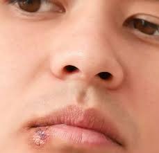 Education for Scar, Stretch Marks & Cold Sores