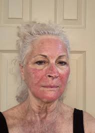 Await results , 3 weeks gone Thursday the biopsy was taken . Said all  characteristics of melanoma. This was done under two week urgent referral  🇬🇧