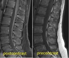 Scott olson / staff / getty images Guillain Barre Syndrome Radiology Case Radiopaedia Org
