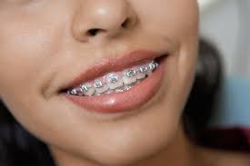 There are no standard requirements for how long you might need to wear braces. Overbite Braces How They Work