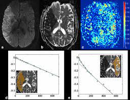 Stroke In The Arteria Cerebri Media Territory On The Right Side Imaged Download Scientific Diagram