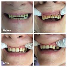 Fillings available on the nhs can be made of: White Fillings Ottawa Tooth Colored Composite Fillings
