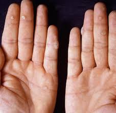 Erst dann kann die richtige form: Lastige Wucherungen Wie Warzen Entstehen Und Was Dagegen Hilft Welt