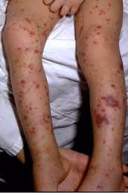 For many students in texas, the cost of college includes the price of a meningitis shot. Making The Case For Meningitis Vaccination Shot Of Prevention