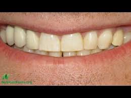 Childhood Tea Drinking May Increase Fluorosis Risk Dental Fluorosis Teeth Health Teeth Treatment
