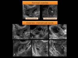 Image result for corpus luteum sonography)