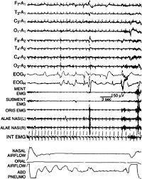 We did not find results for: Sleep Breathing And Neurologic Disorders Springerlink