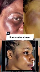 Exfoliating Gloves Sunburn