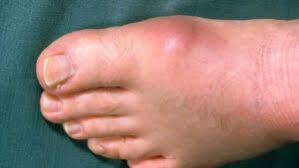 Image result for gout symptoms toe