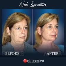 Neck lift in Turkey