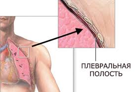 Maybe you would like to learn more about one of these? Ù…Ø§ Ù‡ÙŠ Ø£Ù†ÙˆØ§Ø¹ Pneumothorax Ù…Ø§ Ù‡ÙŠ Ø±Ø¦ØªÙŠ Ø§Ù„Ø±Ø¦ØªÙŠÙ† Ø§Ù„Ø±Ø¦ÙˆÙŠÙŠÙ† Ø§Ù„Ø£Ø³Ø¨Ø§Ø¨ ÙˆØ§Ù„Ø£Ø¹Ø±Ø§Ø¶ ÙˆØ§Ù„Ø¹Ù„Ø§Ø¬