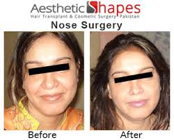 The treatment goal for nasal polyps is to reduce their size or eliminate them. Rhinoplasty In Karachi Pakistan Nose Surgery Nose Job Cost