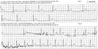 Ekg Heart Rate Chart 2019