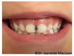Treatment of cavities in front teeth fluoride: Sdf Pediatric Dentistry S New Silver Bullet Pediatric Dental Blog