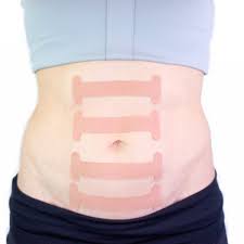 Diastasis recti is a fairly common condition of pregnancy and postpartum in which the right and left halves of rectus abdominis muscle spread. How To Prevent Diastasis Recti After Pregnancy Arxiusarquitectura