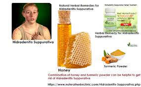 Hidradenitis Suppurativa Herbal Treatment Board Natural Herbs Clinic