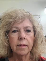 Should I get blepharoplasty or facelift at 72?