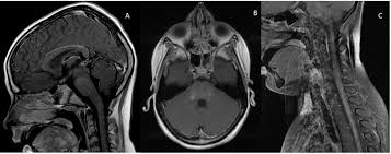 Lasocki a, phillips ka, drummond k, caspersz l. References In Chronic Lymphocytic Inflammation With Pontine Perivascular Enhancement Responsive To Steroids Clippers A Pediatric Case Report With Six Year Follow Up Multiple Sclerosis And Related Disorders