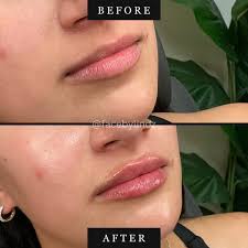 ✨ Hydrated, Juicy Lips — Before & After ✨ Subtle. Soft. Stunning. This is  the perfect example of what a little hydration and expert lip filler can do  💉💋 Our beautiful client